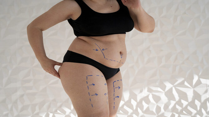 Liposuction ile Karın, Basen ve Bacak Bölgesinde İncelme Nasıl Sağlanır?